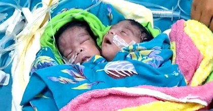 রাজশাহীতে দুই মাথার শিশুর জন্ম